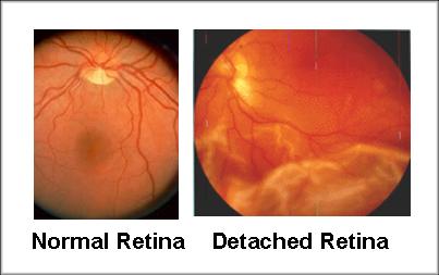 retinal detached